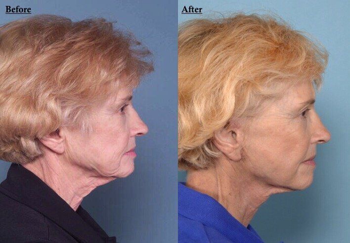 A before and after photo of a woman 's face.