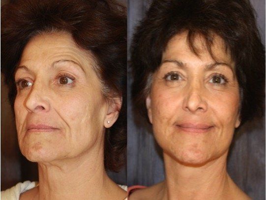 A before and after photo of a woman 's face