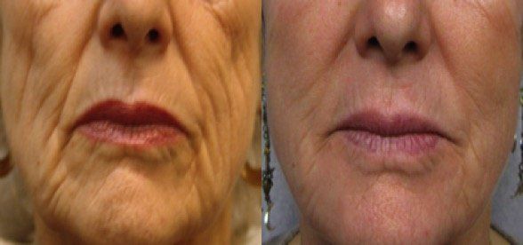 A before and after photo of a woman 's face