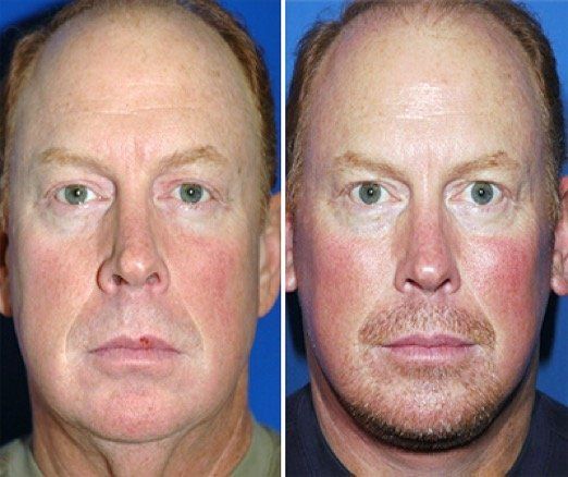 A before and after photo of a man with a beard.