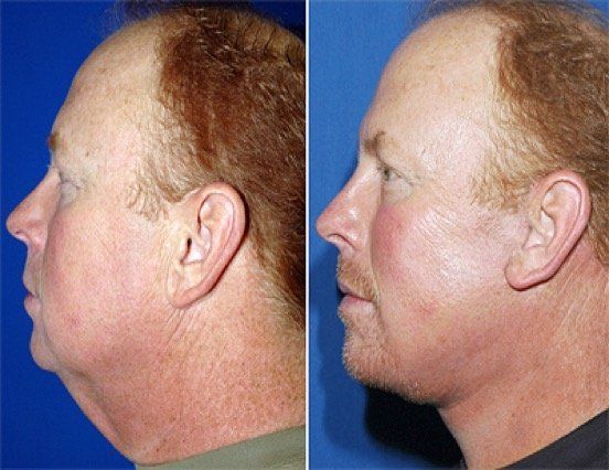 A before and after photo of a man 's face