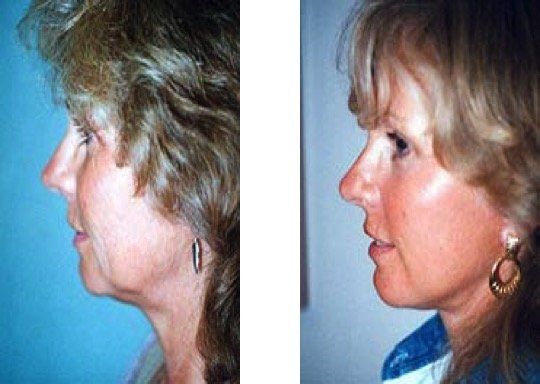 A before and after photo of a woman 's face.