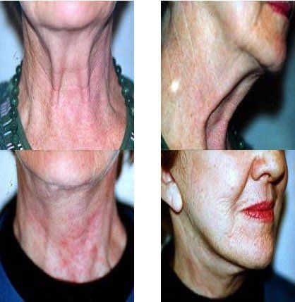 A before and after photo of a woman 's neck and face.