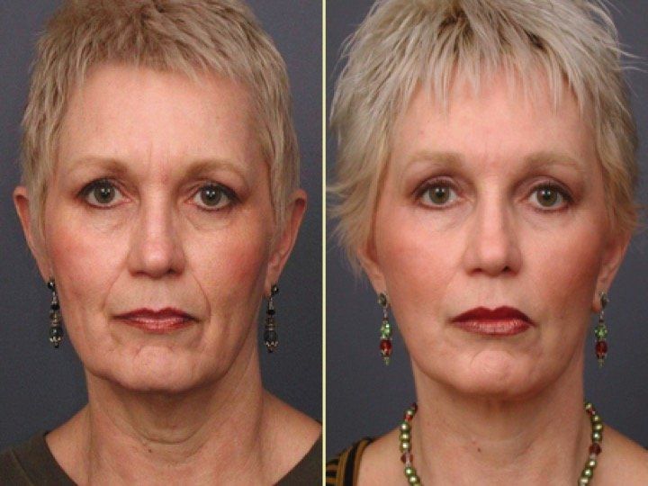 A before and after photo of a woman 's face
