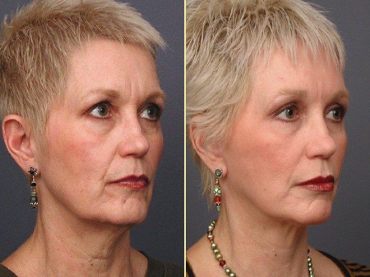 A before and after photo of a woman 's face