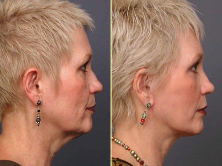 A before and after photo of a woman 's face and neck.