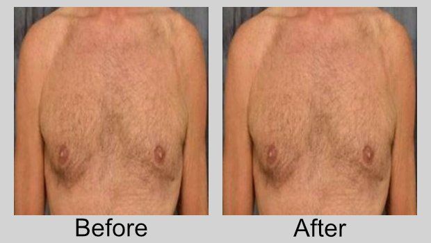 Two pictures of a man 's chest before and after surgery