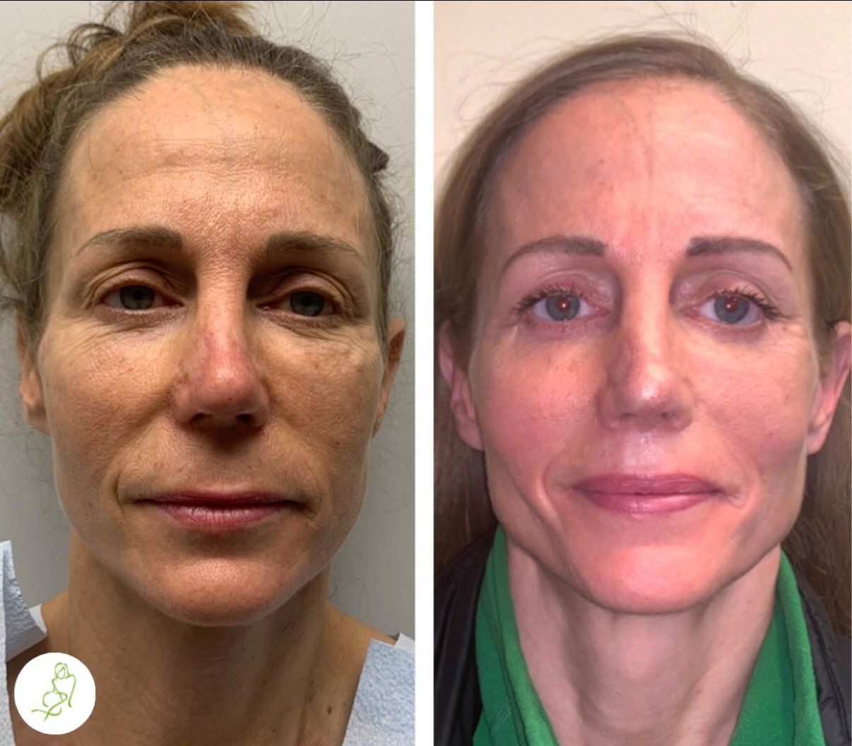 A before and after photo of a woman 's face.