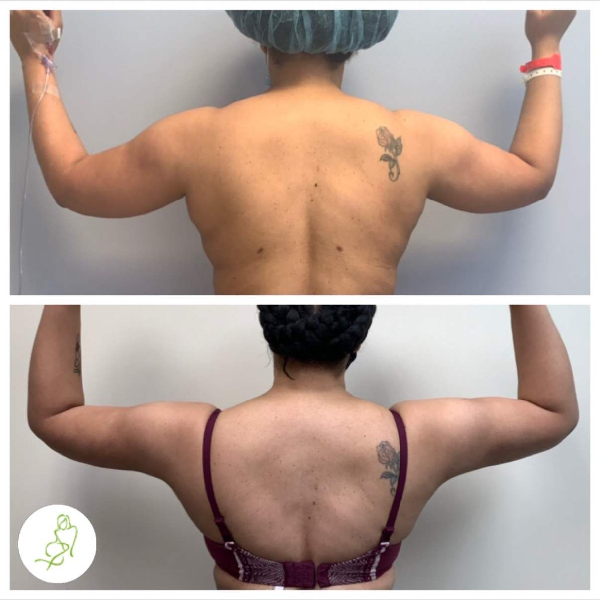 A before and after photo of a woman 's back and arms