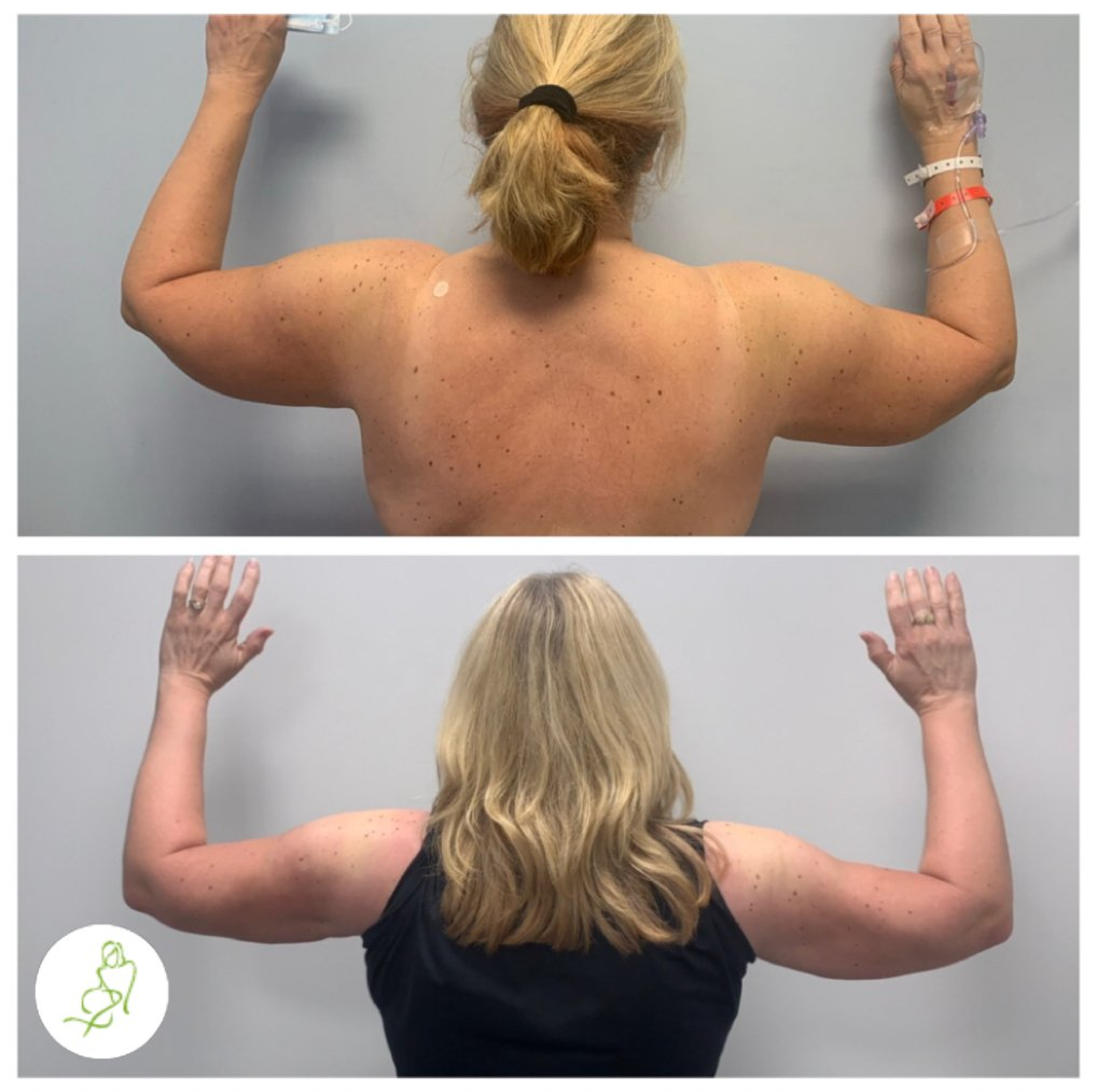 A before and after photo of a woman 's arms