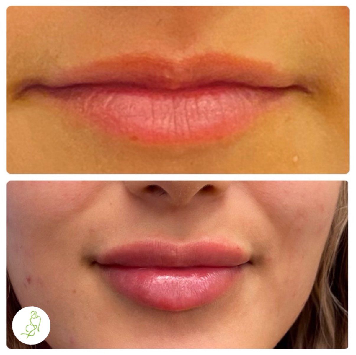 A before and after photo of a woman 's lips.