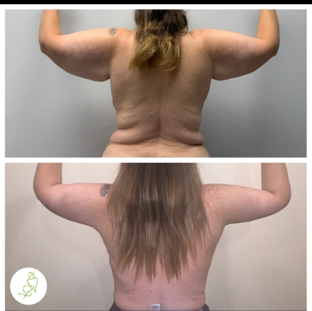 A before and after photo of a woman 's back and arms