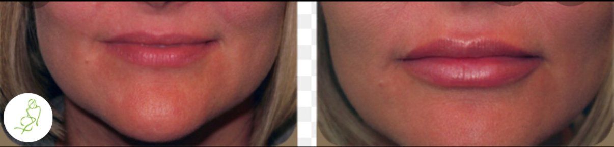 A before and after picture of a woman 's lips.