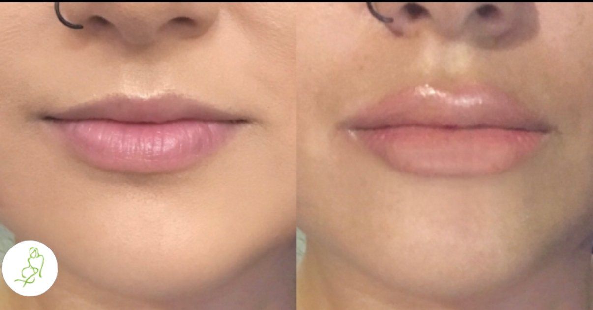 A before and after picture of a woman 's lips.