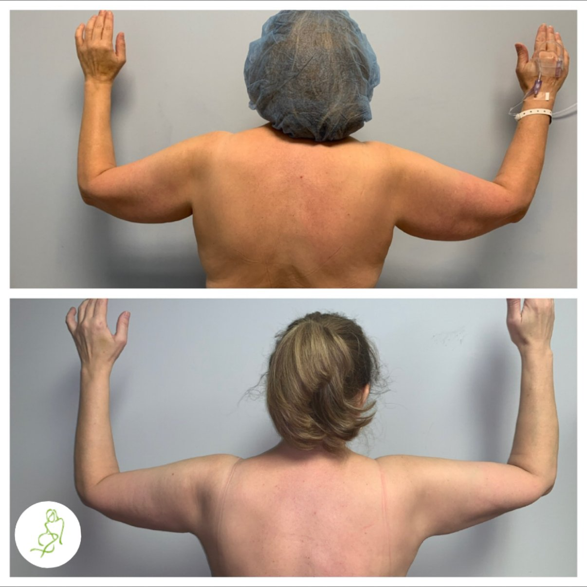 A before and after photo of a woman 's arms