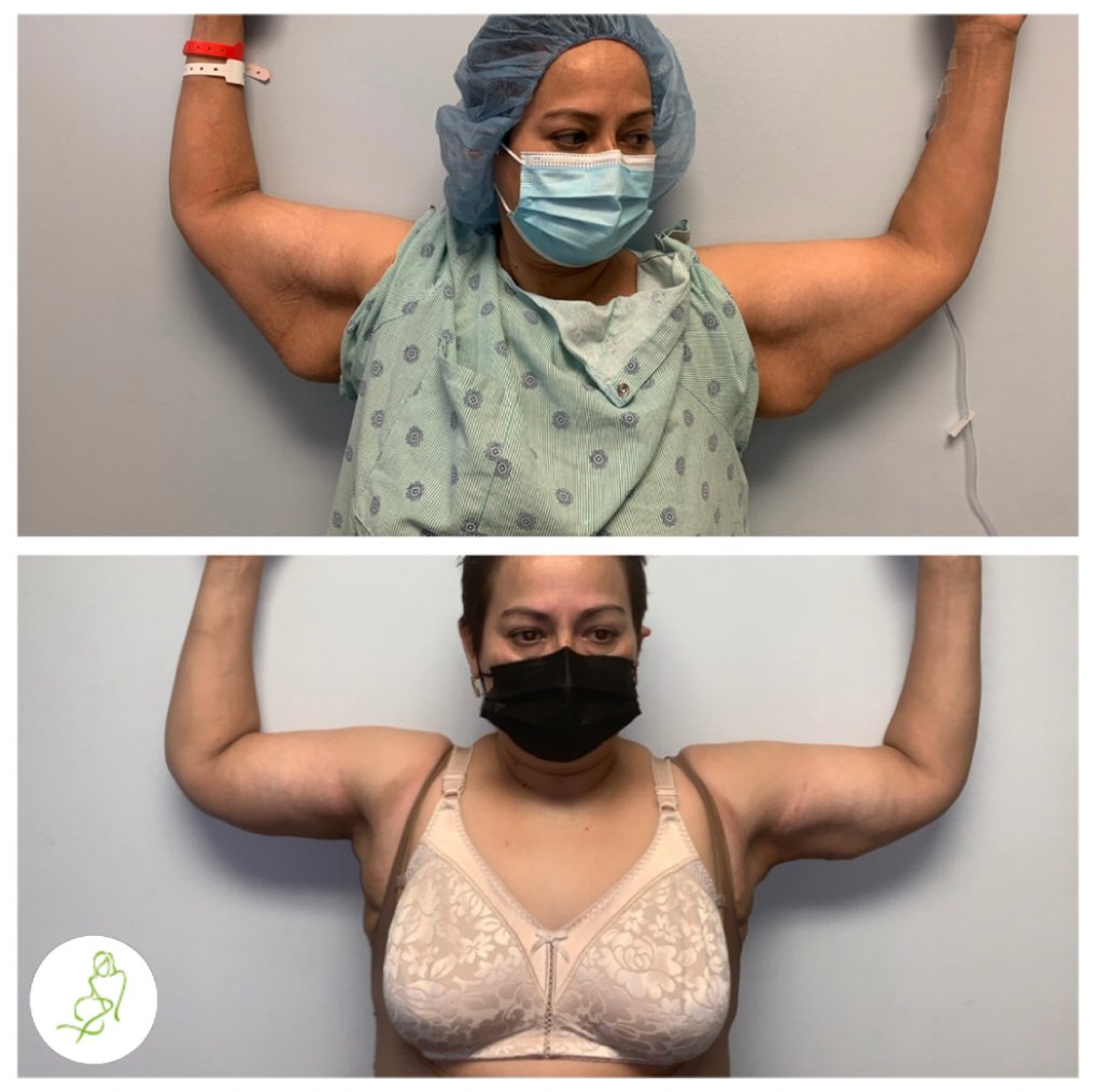 A before and after photo of a woman wearing a mask