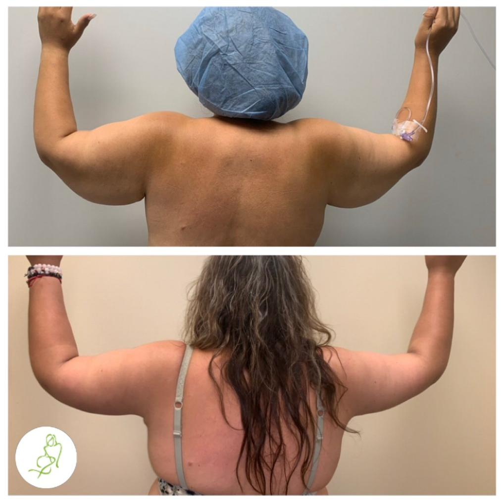 A before and after photo of a woman 's arms
