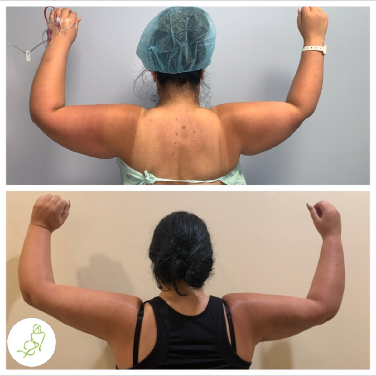 A before and after photo of a woman 's arms