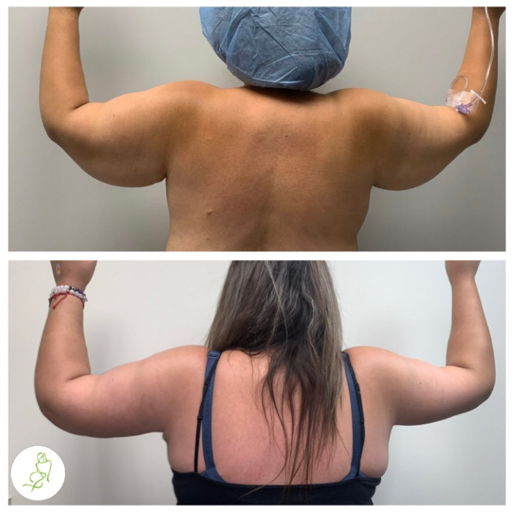 A before and after photo of a woman 's arms