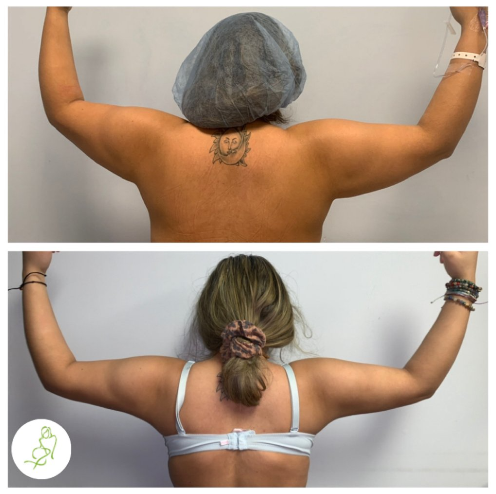 A before and after photo of a woman 's arms