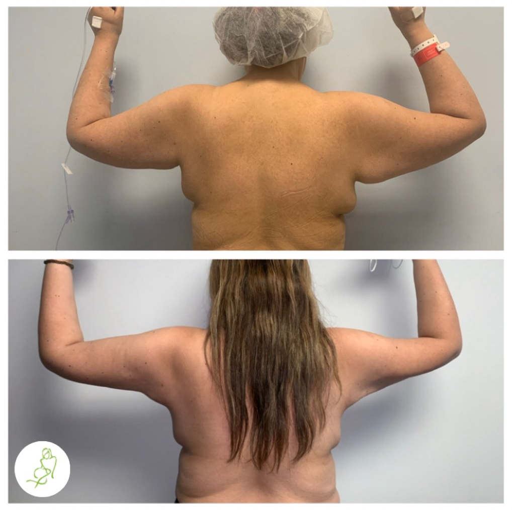 A before and after photo of a woman 's arms