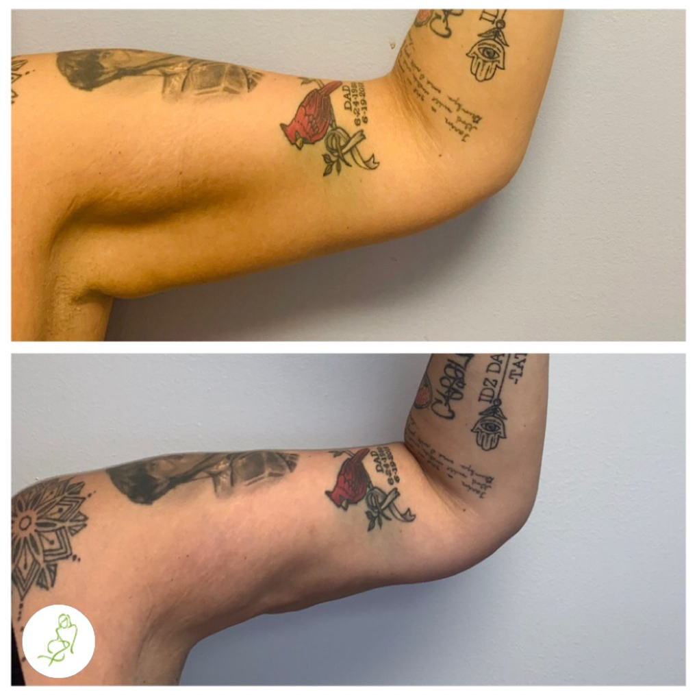 A before and after photo of a woman 's arm with tattoos