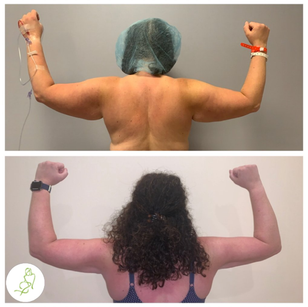 A before and after photo of a woman 's arms