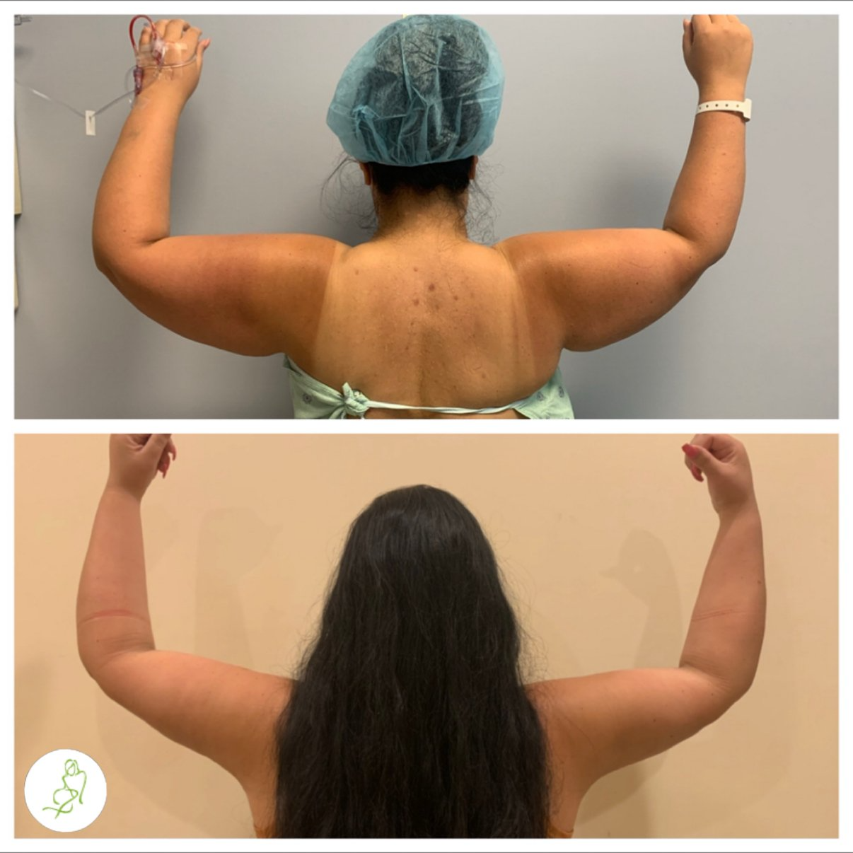 A before and after photo of a woman 's arms