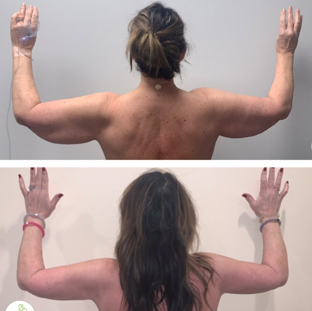 A before and after photo of a woman 's arms