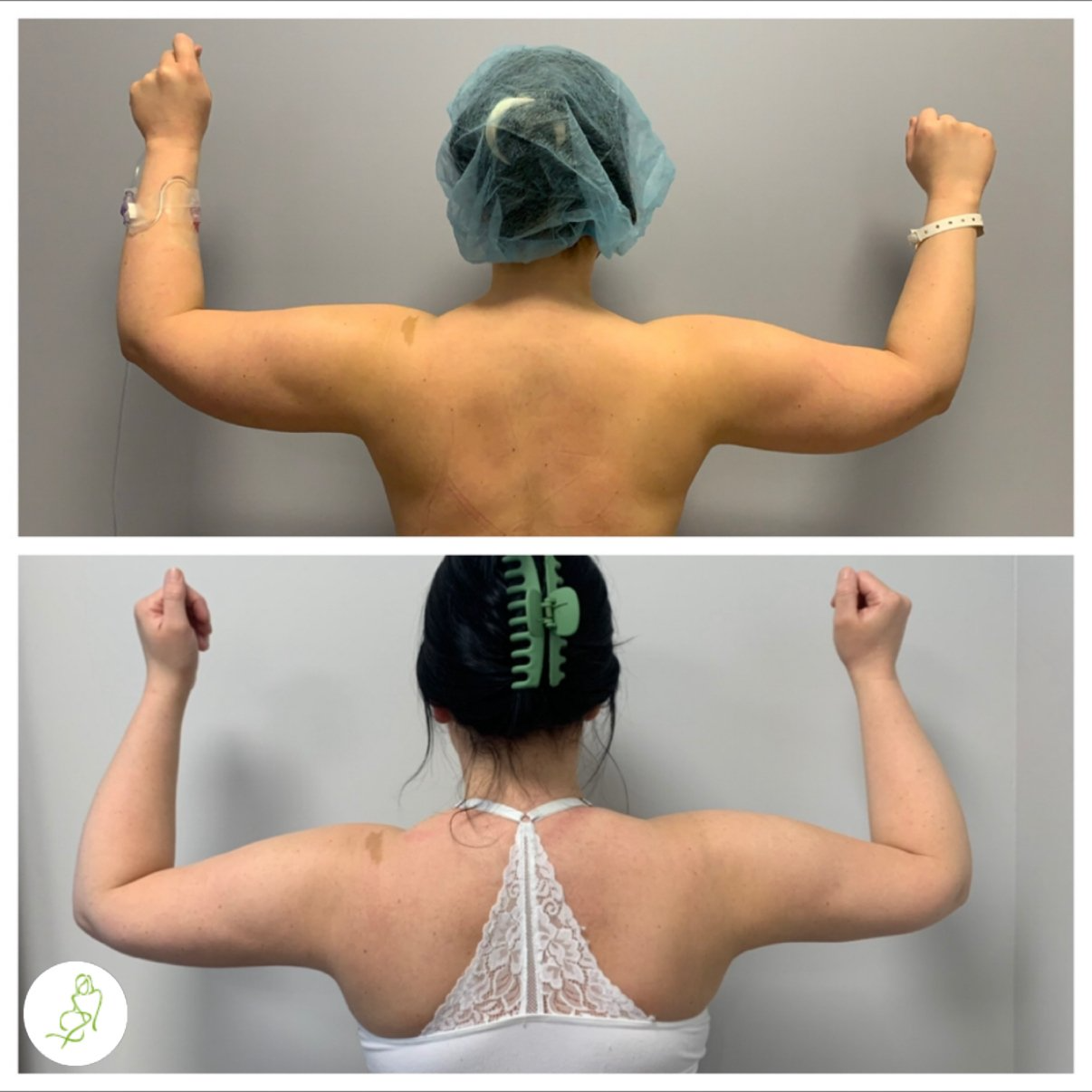 A before and after photo of a woman 's arms