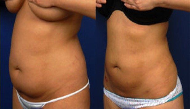 A before and after picture of a woman 's stomach.