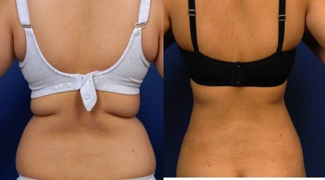 A before and after picture of a woman 's back