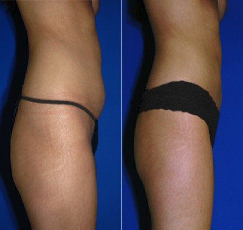 A before and after photo of a woman 's torso