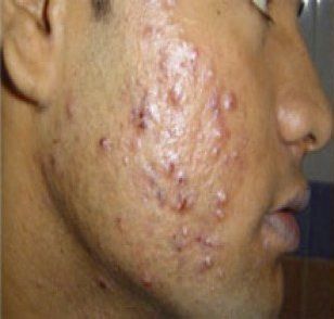 A close up of a man 's face with acne on it