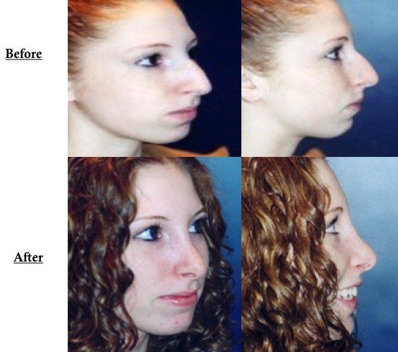 A before and after photo of a woman 's face