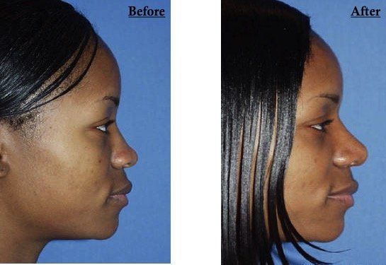 A before and after photo of a woman 's face