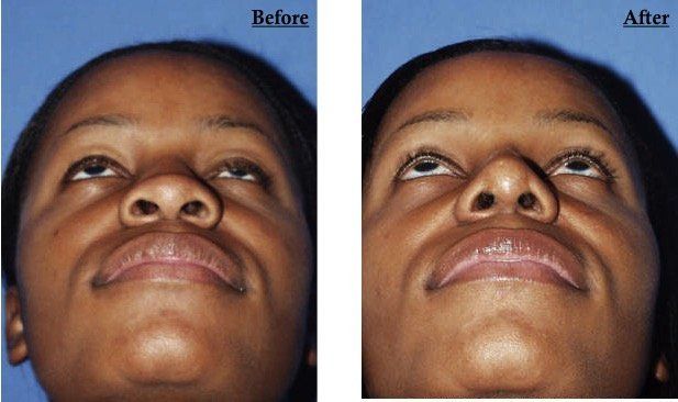 A before and after photo of a woman 's face