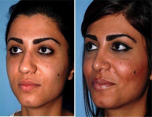 A before and after photo of a woman 's face