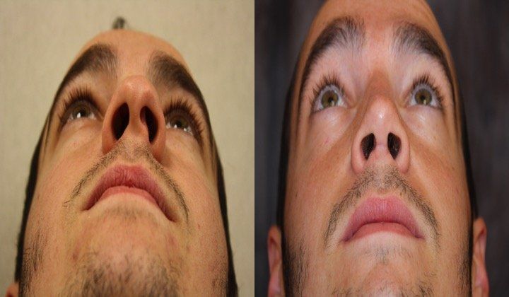 A before and after photo of a man 's nose.