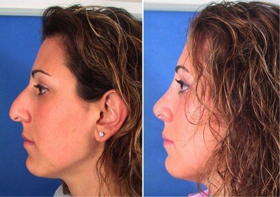 A before and after picture of a woman 's nose