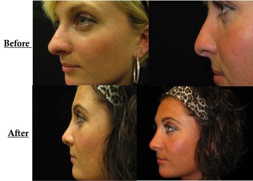 A before and after picture of a woman 's nose