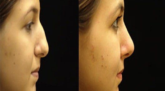 A before and after photo of a woman 's nose.