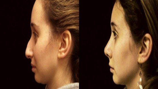 A before and after photo of a woman 's nose surgery.