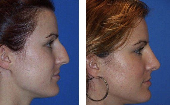 A before and after photo of a woman 's nose surgery.