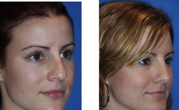 A before and after photo of a woman 's face.