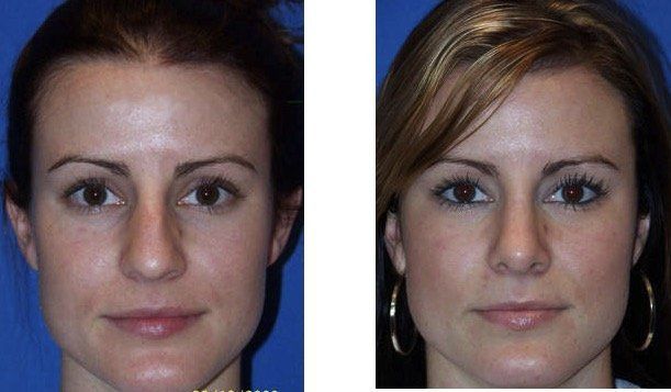 A before and after photo of a woman 's face