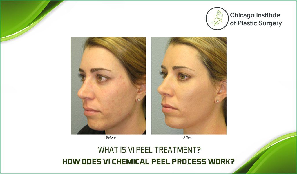 What is VI Peel Treatment? How Does The VI Chemical Peel Process Work?