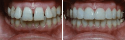 Cleaning — Dental Treatment Before and After in Joliet, IL