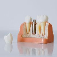 Dental implant model with a missing tooth and removable crown on a pink gum base