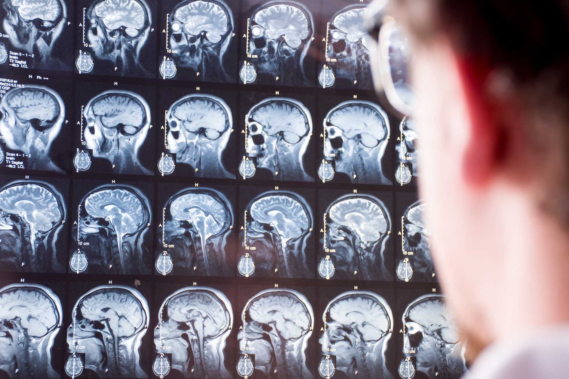 Person reviewing multiple MRI brain scan images displayed on a screen.